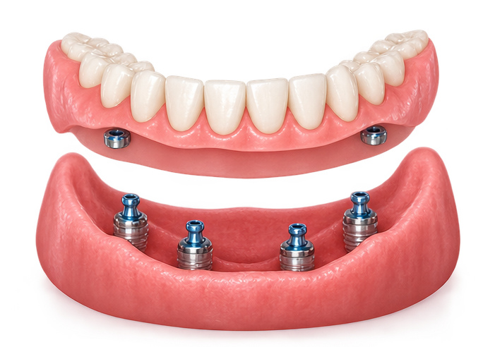 Implant overdentures dental treatment
